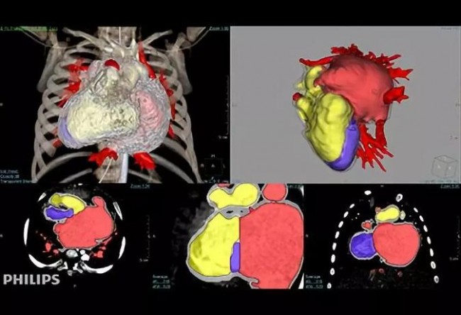 Highlights l 盘点FDA 批准的医疗模型3D打印软件及医学影像巨头对该市场的渗透